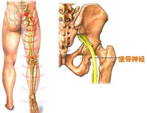 坐骨神经痛的症状 坐骨神经痛的症状在哪个部位