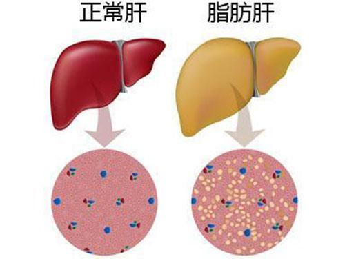 脂肪肝怎么调理 脂肪肝怎么调理饮食注意事项