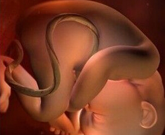 胎儿脐带绕颈怎么办（b超显示胎儿脐带绕颈怎么办）