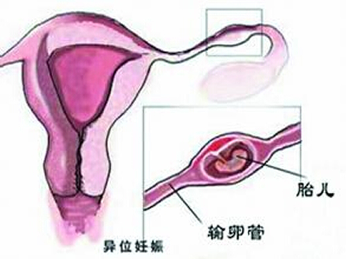 宫外孕是怎么引起的 持续性宫外孕是怎么引起的