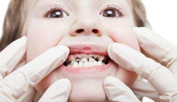 如何保护牙齿预防蛀牙（怎样保护牙齿预防蛀牙）