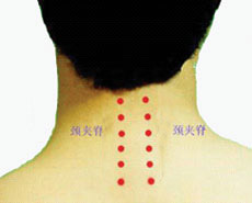颈椎病针灸穴位图（颈椎病针灸位置图）