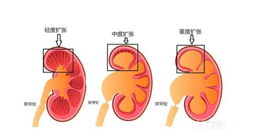 肾积水有哪些症状 肾积水有哪些症状最为明显