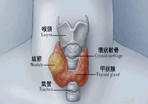 甲状腺结节能治愈吗（恶性甲状腺结节能治愈吗）