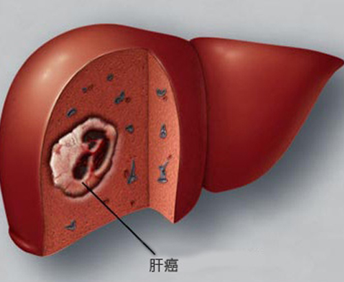 肝癌的早期症状 肝癌的早期症状能活多久