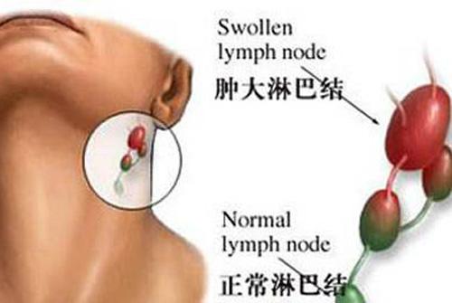 EB病毒感染淋巴结肿大 eb病毒感染淋巴结肿大不消