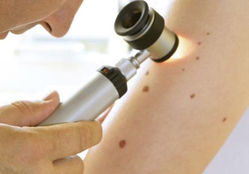 皮肤癌早期症状图片 皮肤癌早期症状图片皮肤瘙痒