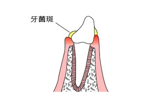 牙周炎是什么原因引起的 经常牙周炎是什么原因引起的