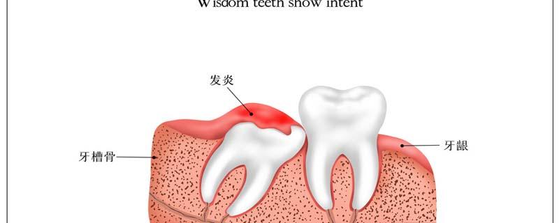 夏天能不能拔智齿 夏天拔智齿注意事项