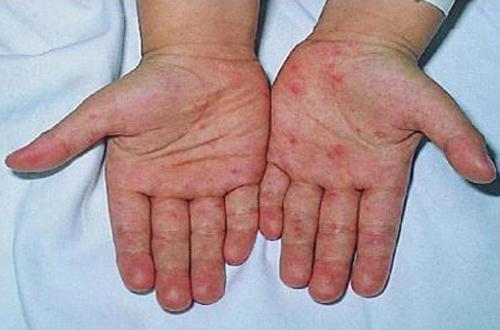 手足口病初期症状 手足口病初期症状有哪些