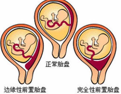 前置胎盘是怎样造成的 前置胎盘是怎样造成的视频