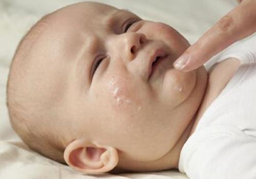 宝宝湿疹是什么原因引起的 宝宝湿疹是什么原因引起的有必要换奶粉吗