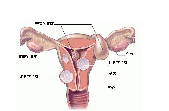 子宫肌瘤常见并发症（子宫肌瘤常见并发症错误的是）