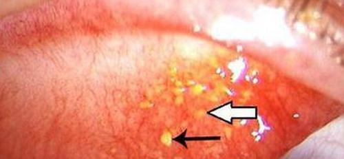 上眼皮里面长了个小白点是怎么回事 上眼皮里面长小白点儿是什么原因?