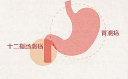 胃溃疡症状表现有哪些（胃溃疡症状表现有哪些吃什么食物）