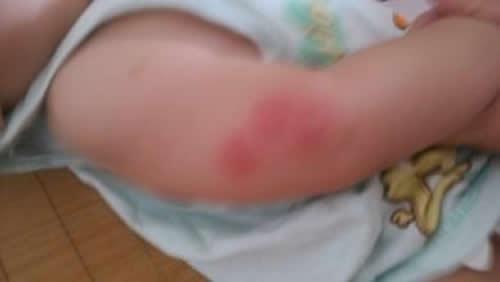 宝宝被蚊子咬后肿得很大怎么办 十个月宝宝被蚊子咬后肿得很大怎么办