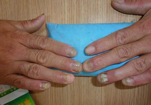 灰指甲会传染别人吗 真菌感染灰指甲会传染别人吗