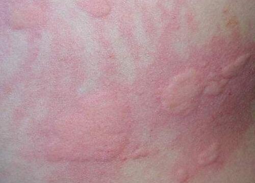 秋季荨麻疹会不会传染 季节性荨麻疹会传染吗?