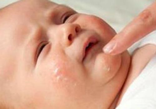 治疗婴儿湿疹最快的方法 宝宝湿疹怎么治疗最快的方法