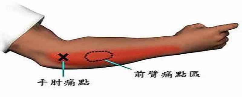 网球肘艾灸要哪个位置 网球肘的艾灸疗法