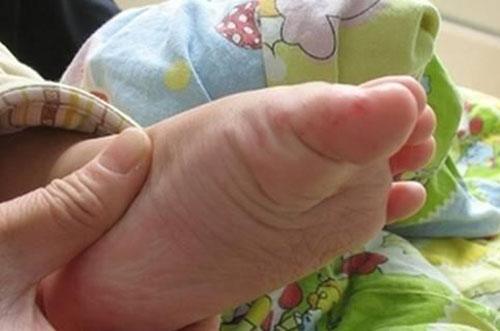 手足口病的预防措施（简述幼儿手足口病的预防措施）