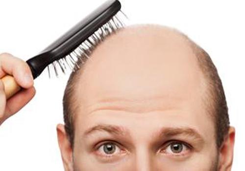 男性脱发是什么原因引起的（男性脱发是什么原因引起的怎么治疗）