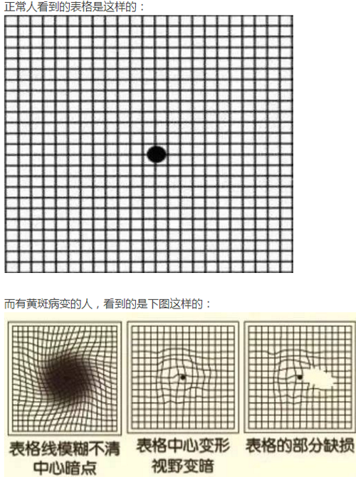 眼睛看东西变形扭曲是什么原因（眼睛看东西变形扭曲是什么原因用什么药）