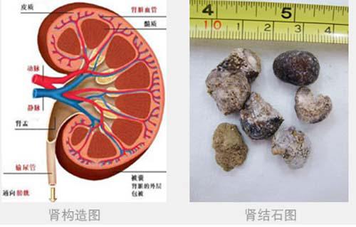 肾结石需要做手术吗（肾结石到什么程度需要做手术）