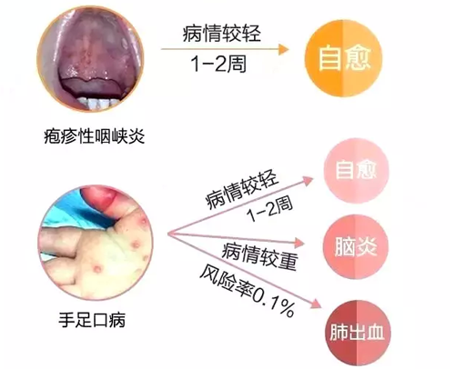 疱疹性咽峡炎和手足口病的区别（疱疹性咽峡炎和手足口病的区别症状）