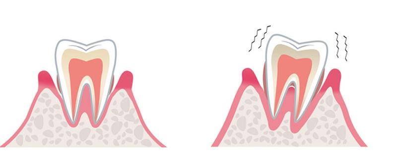 缓解牙疼的8个简单方法（蛀牙缓解牙疼的8个简单方法）