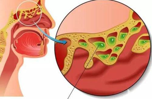鼻窦炎有哪些症状（鼻窦炎有哪些症状图片）