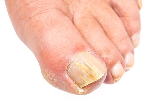 怎么确定是不是灰指甲 怎么确定是不是灰指甲 早期症状
