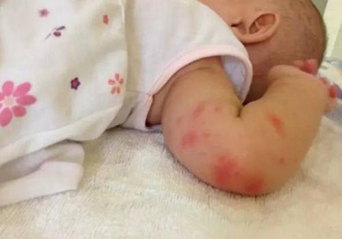 宝宝被蚊子叮了有疤自己会消吗 宝宝被蚊子咬了有疤