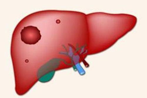肝癌有哪些典型的症状（肝癌最典型的症状）