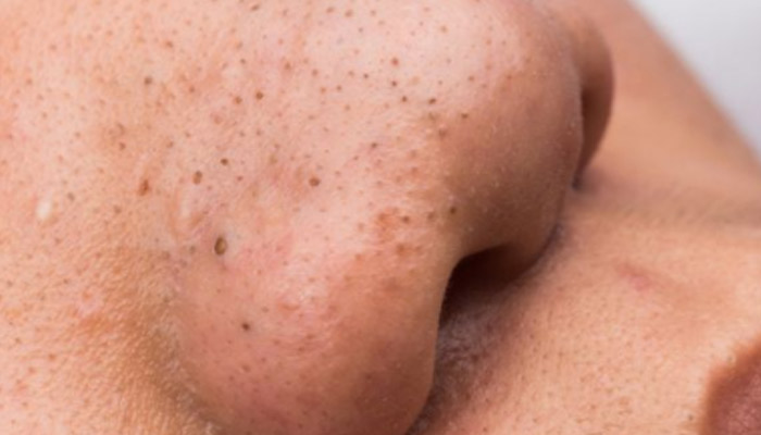 脸上黑头毛孔粗大怎么去除 脸上黑头毛孔粗大如何去除