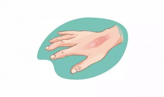 被热水烫到怎么办 被热水烫到怎么办用什么办法止疼