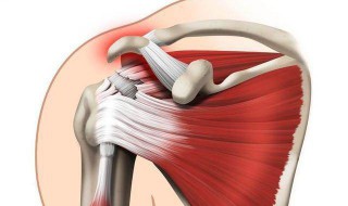 肌肉拉伤怎么快速恢复 肌肉拉伤怎么快速恢复用什么膏药