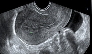 产科超声检查和b超有什么区别 产科超声检查是b超吗