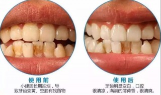 怎么让牙齿变白（怎么让牙齿变白又不伤害牙齿）
