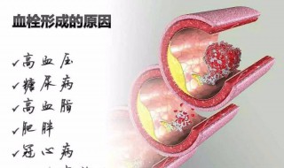 血栓是什么（血栓是什么意思）