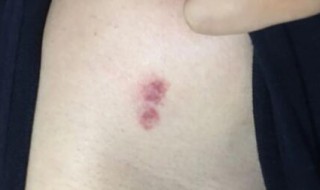 刚种的吻痕热敷还是冷敷（吻痕是先热敷还是冷敷）
