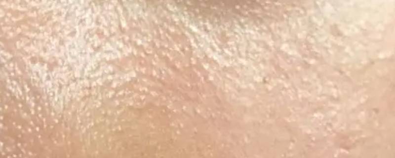 什么是油皮 什么是油皮和混油皮
