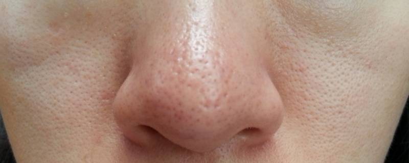 怎样去黑头？（怎样去黑头小学生）