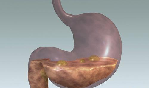 胃炎是怎么引起的 急性肠胃炎是怎么引起的