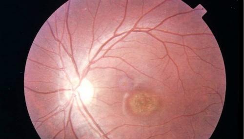 神经炎的症状（神经炎的症状和原因）