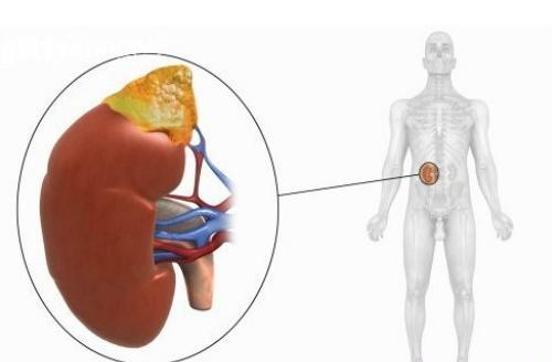 肾炎的早期症状 肾炎的早期症状表现有哪些