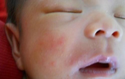 婴儿脸上起小红疙瘩（婴儿脸上起小红疙瘩那是湿疹吗）