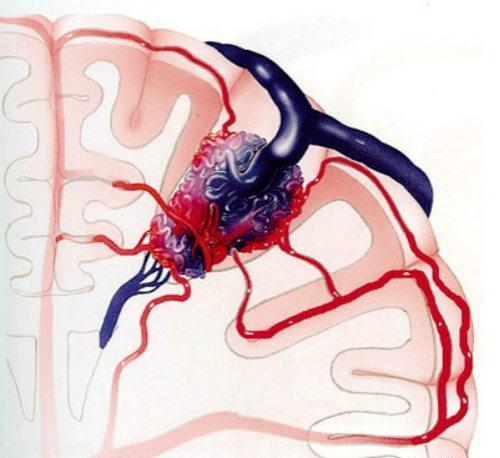 脑动静脉畸形 脑动静脉畸形严重吗