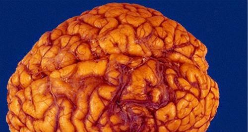 脊髓血管畸形 脊髓血管畸形瘫痪了能治好吗