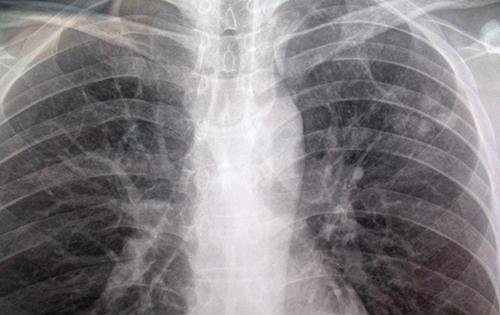 肺结核胸片（肺结核胸片影像图片）